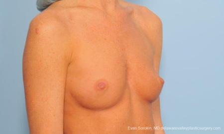 Philadelphia Breast Augmentation 9179 - Before Image 2