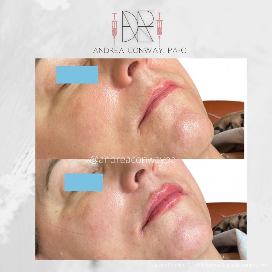 Fillers: Patient 52 - Before and After 1