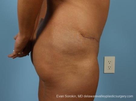 Philadelphia Abdominoplasty 8700 - After Image 4