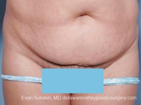 Philadelphia Abdominoplasty 8672 - Before Image 1