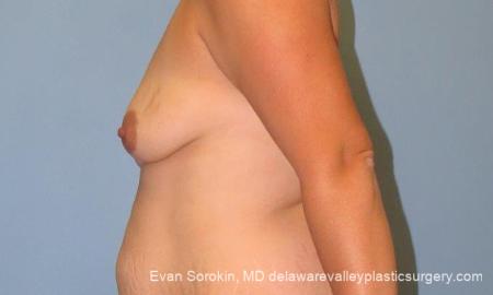 Philadelphia Breast Lift and Augmentation 10123 - Before and After Image 5