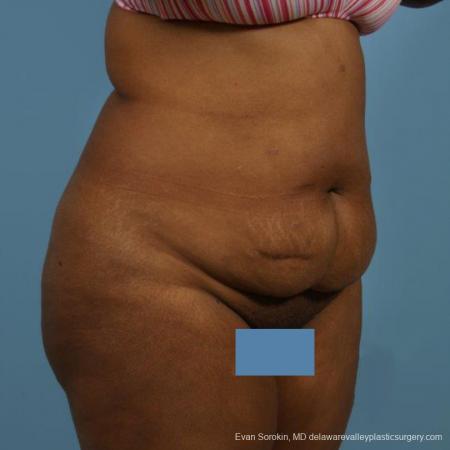 Philadelphia Abdominoplasty 9472 - Before Image 2
