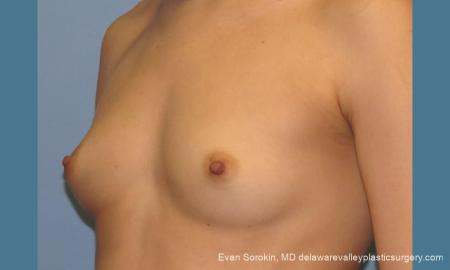Philadelphia Breast Augmentation 10097 - Before Image 4