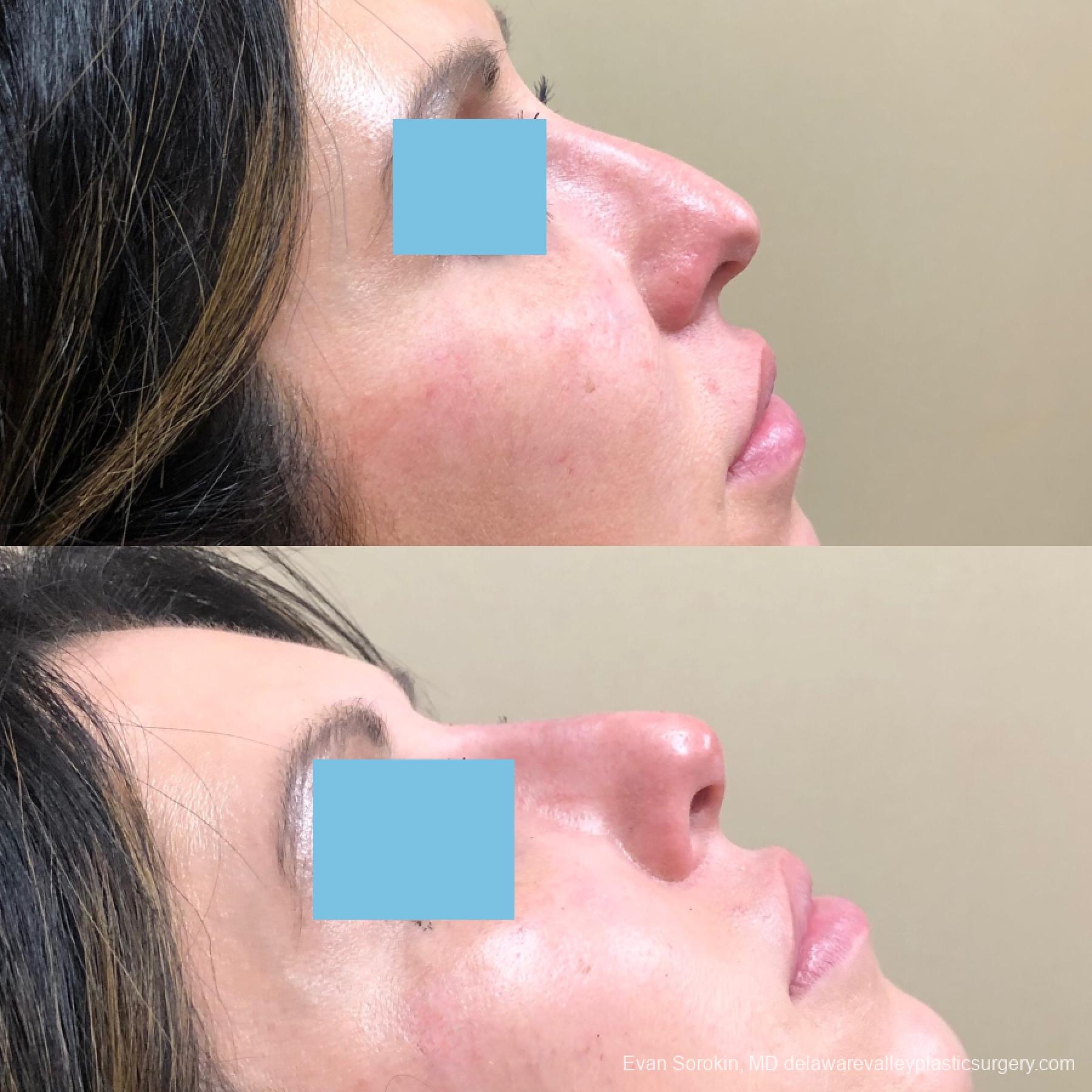 Fillers: Patient 47 - Before and After 