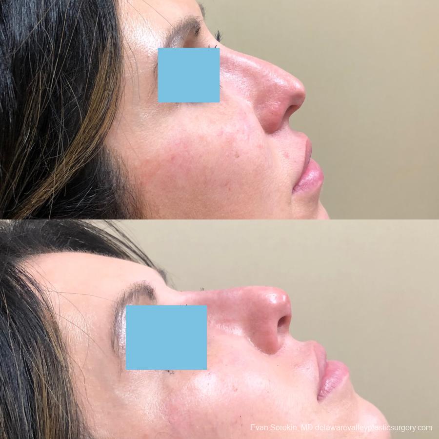 Fillers: Patient 47 - Before and After 1