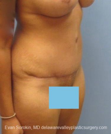 Philadelphia Abdominoplasty 8825 - After Image 2
