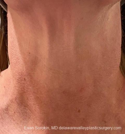 Microneedling: Patient 1 - After 1