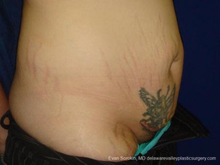 Philadelphia Abdominoplasty 9473 - Before Image 2
