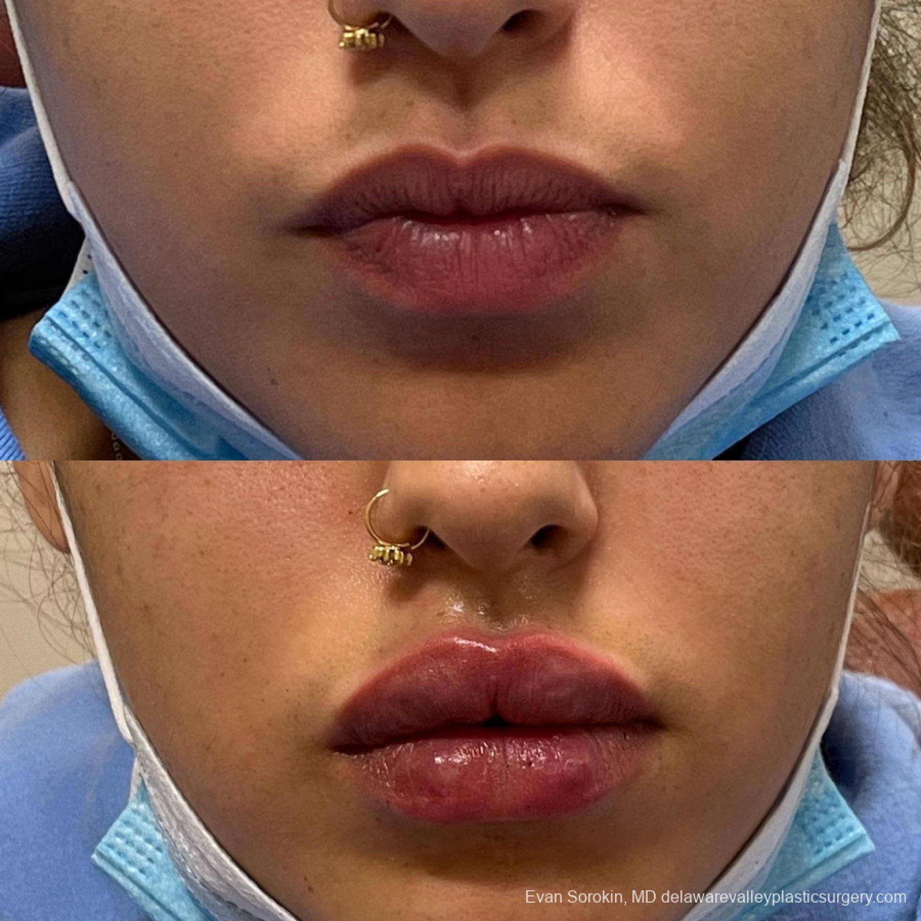 Lip Filler: Patient 4 - Before and After 