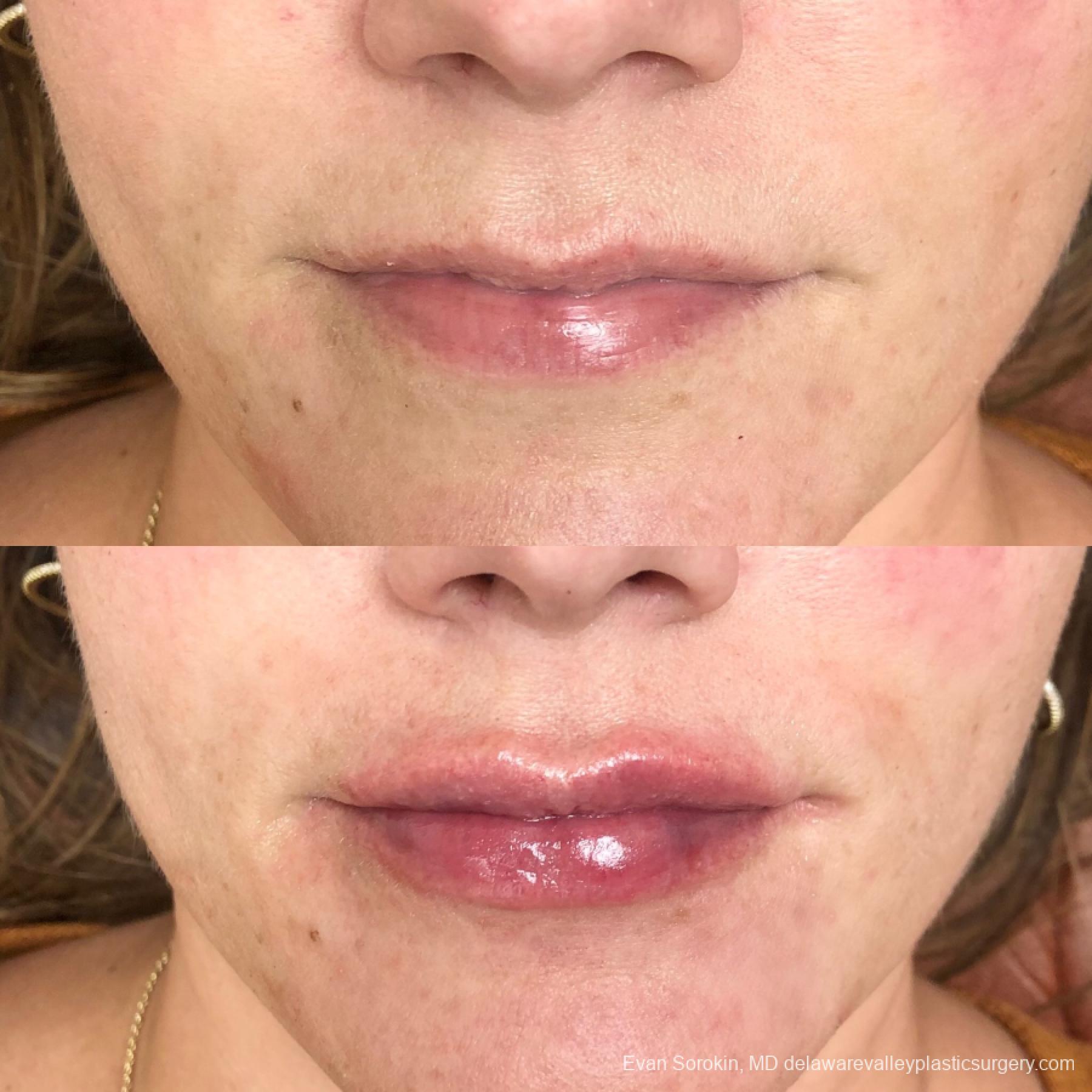 Lip Augmentation: Patient 27 - Before and After 