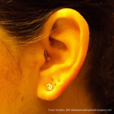 Philadelphia Earlobe Surgery 9384 - After Image 4