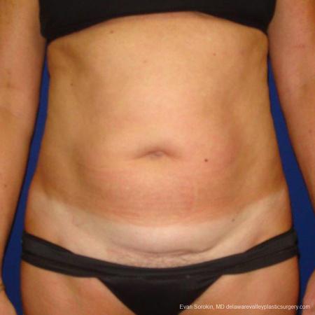 Philadelphia Liposuction 9488 - Before Image 1