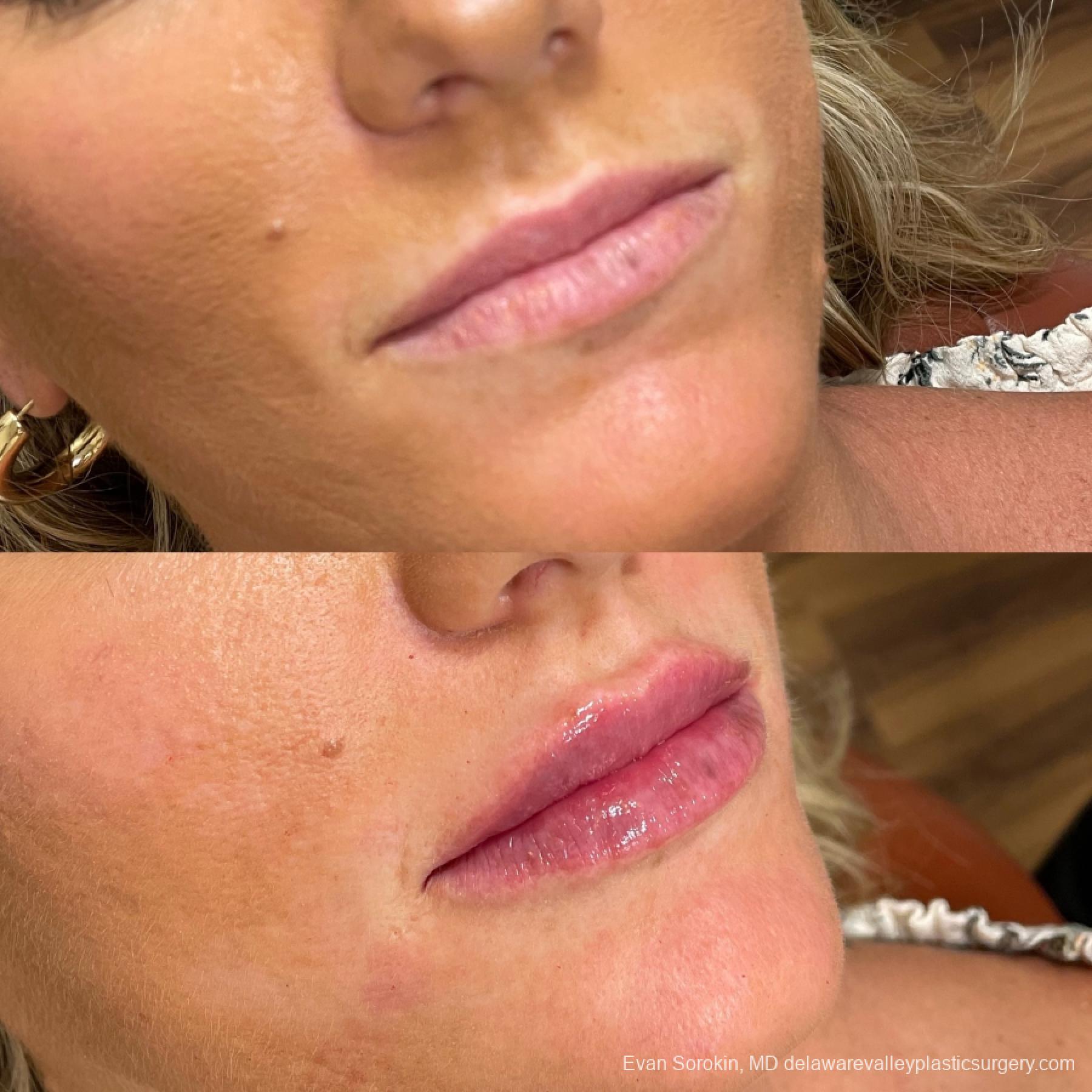 Lip Filler: Patient 38 - Before and After 2
