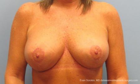 Philadelphia Breast Lift and Augmentation 9398 - After Image 1
