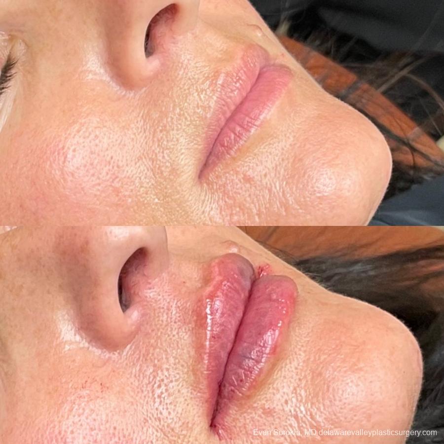Lip Filler: Patient 21 - Before and After 1