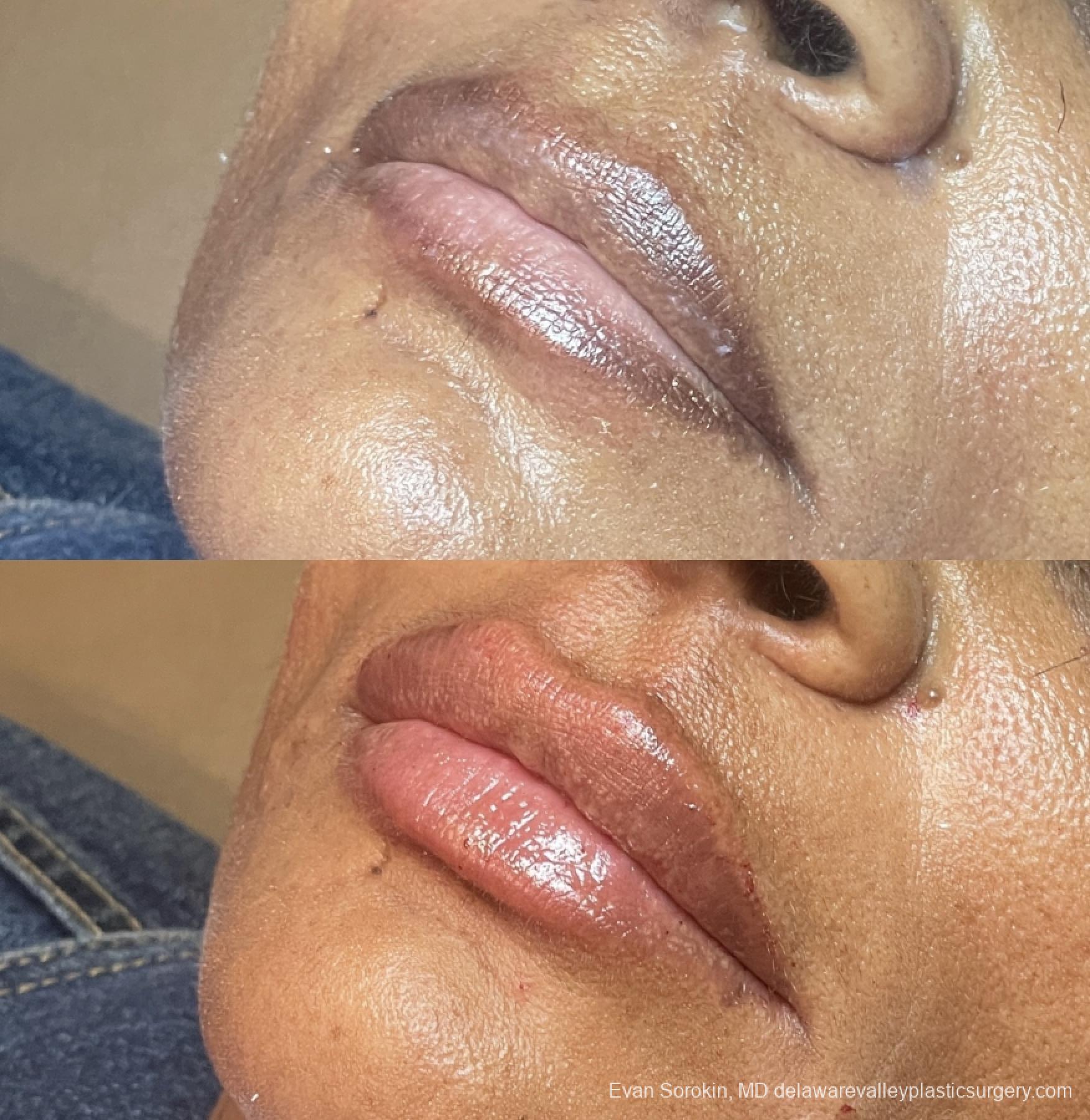 Lip Augmentation: Patient 47 - Before and After 3