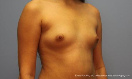 Philadelphia Breast Augmentation 9194 - Before Image 2