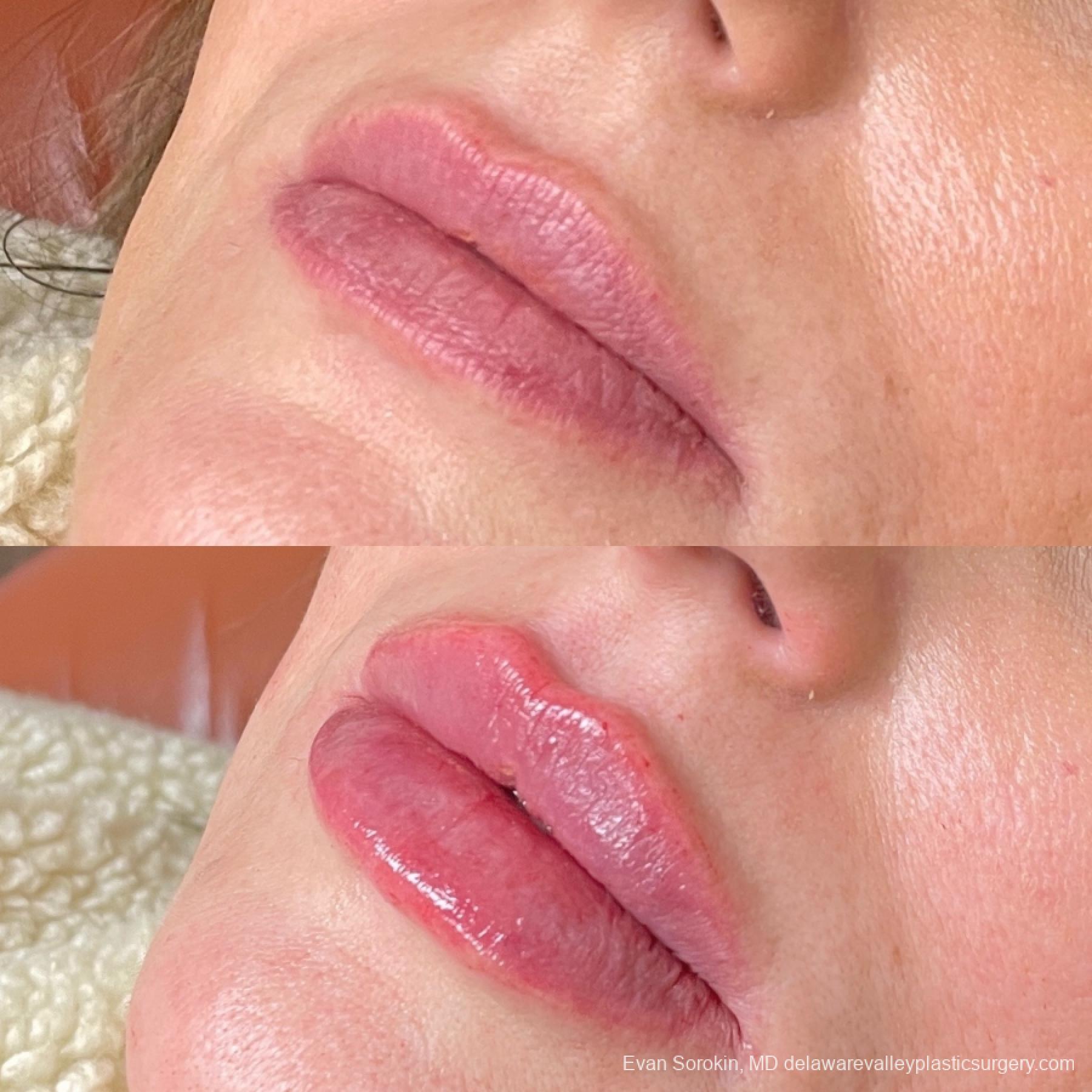 Lip Filler: Patient 62 - Before and After 3