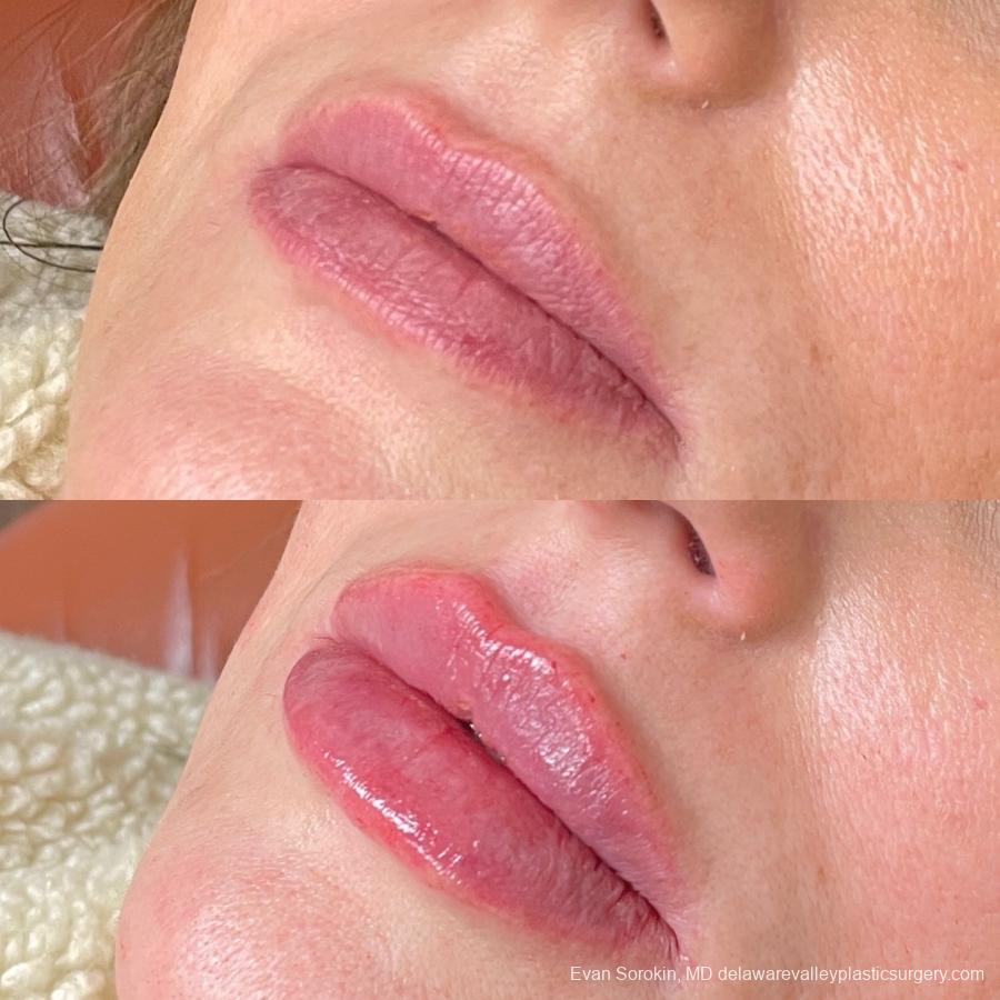 Lip Filler: Patient 63 - Before and After 3