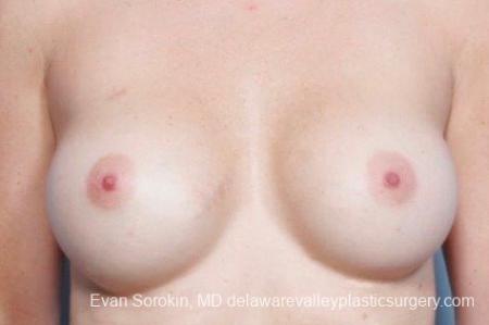 Philadelphia Breast Augmentation 8776 - After Image 1
