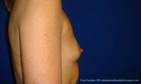 Philadelphia Breast Augmentation 9412 - Before Image 3