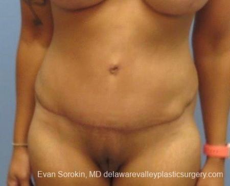 Philadelphia Abdominoplasty 8825 - After Image 1