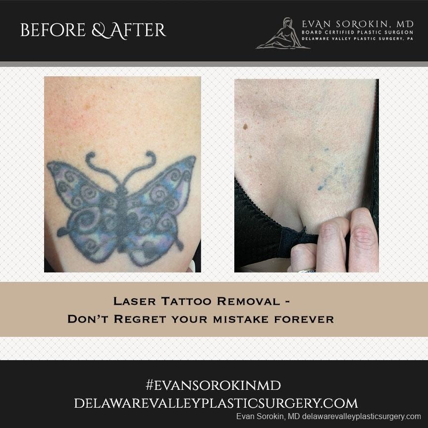 Tattoo Removal: Patient 3 - Before and After 1