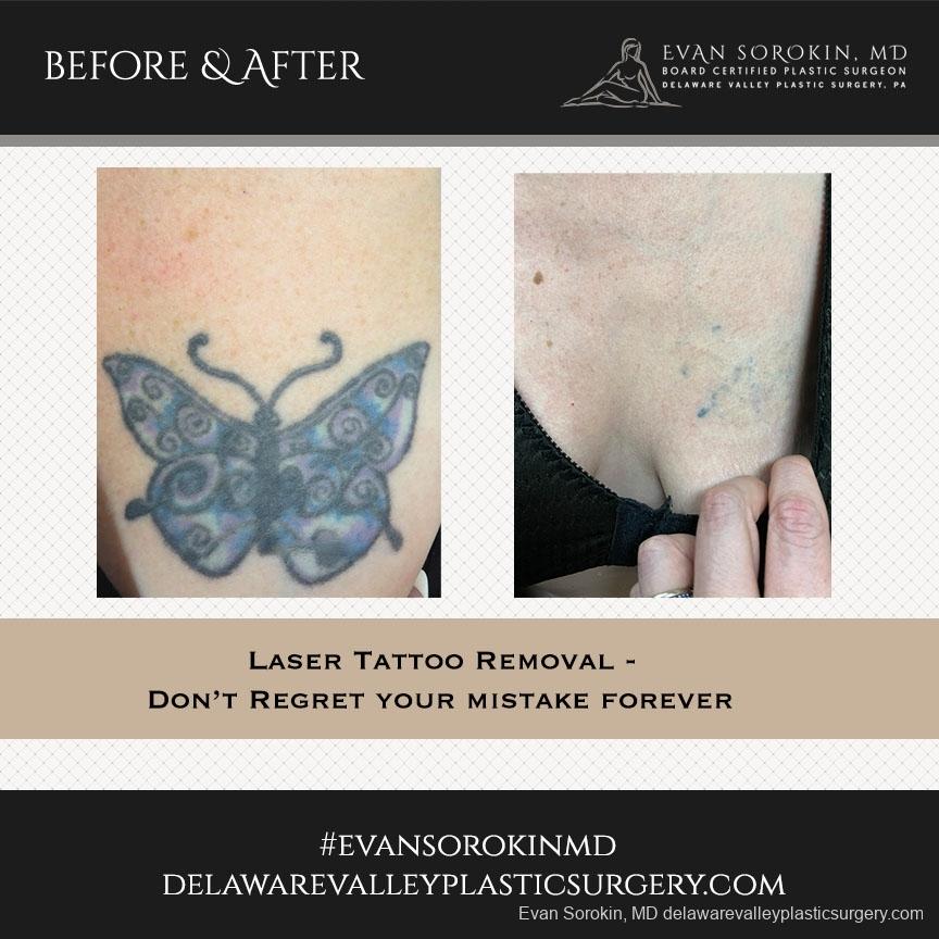 Tattoo Removal: Patient 3 - Before and After