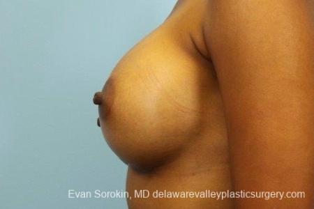 Philadelphia Breast Augmentation 8768 - After Image 5