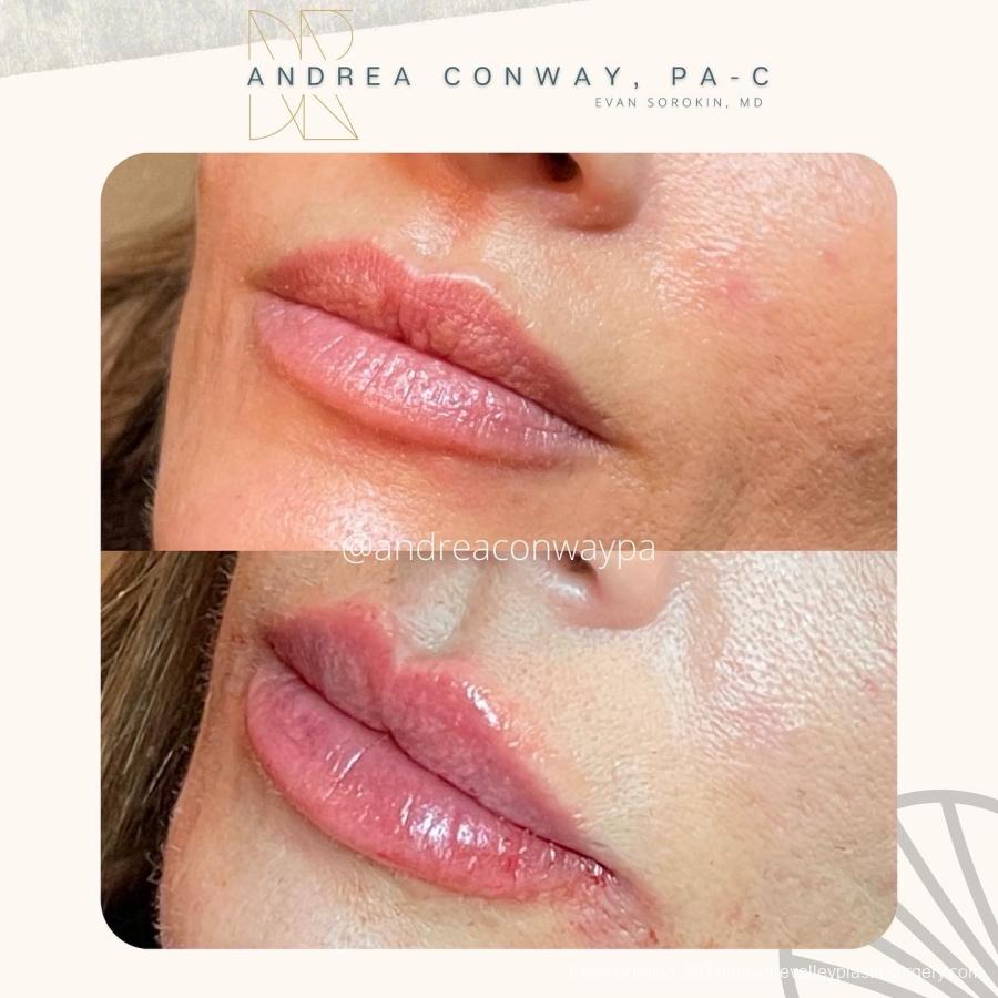 Lip Augmentation: Patient 31 - Before and After 3