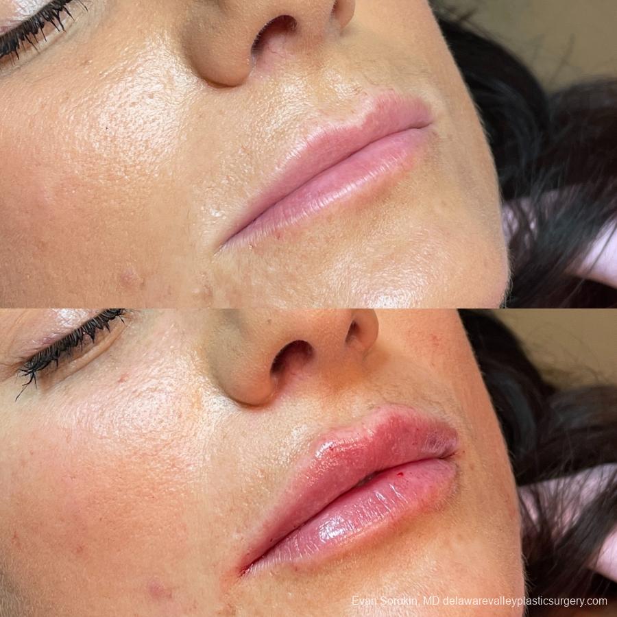 Lip Augmentation: Patient 6 - Before and After 2