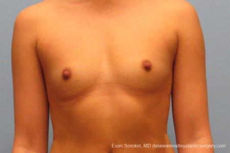 Philadelphia Breast Augmentation 9410 - Before Image 1