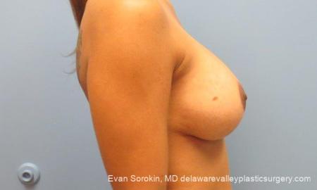 Philadelphia Breast Lift and Augmentation 10119 - After Image 3