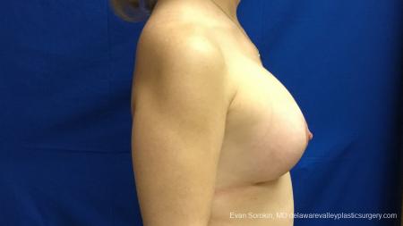 Philadelphia Breast Lift and Augmentation 13179 - After Image 2