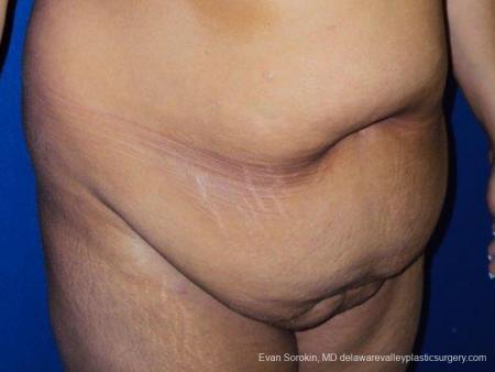 Philadelphia Abdominoplasty 9471 - Before Image 2