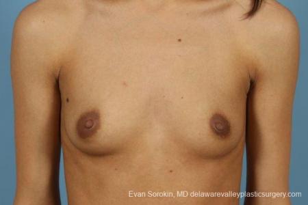 Philadelphia Breast Augmentation 9411 - Before Image 1