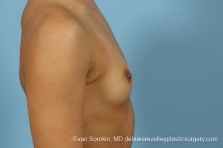 Philadelphia Breast Augmentation 9408 - Before Image 3