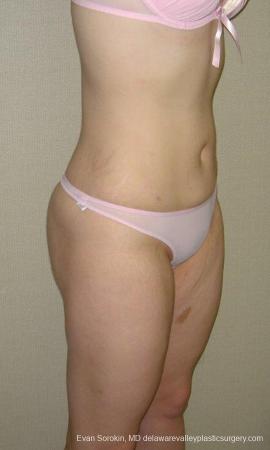 Philadelphia Liposuction 9480 - After Image 2