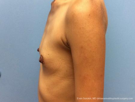 Philadelphia Breast Augmentation 13071 - Before and After Image 4