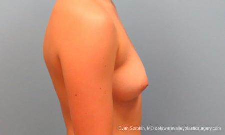 Philadelphia Breast Augmentation 9386 - Before Image 3