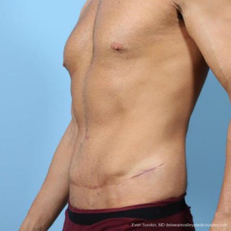 Philadelphia Abdominoplasty 9468 - After Image 4