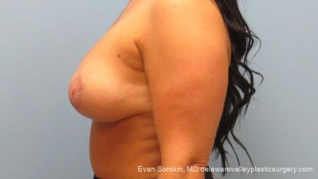 Philadelphia Breast Augmentation 10089 - After Image 5