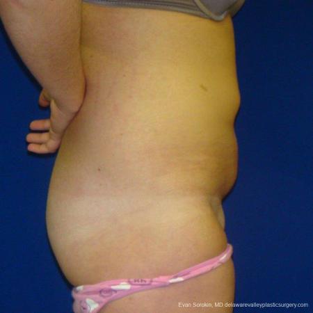 Philadelphia Liposuction 9484 - Before Image 4