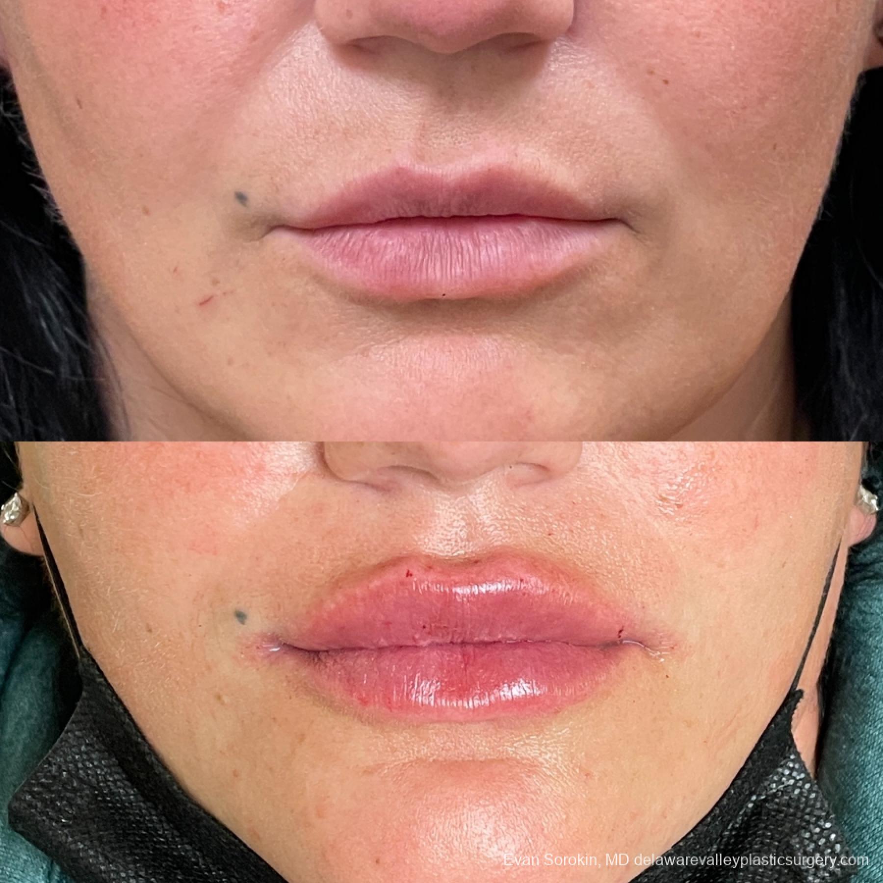 Lip Augmentation: Patient 1 - Before and After  