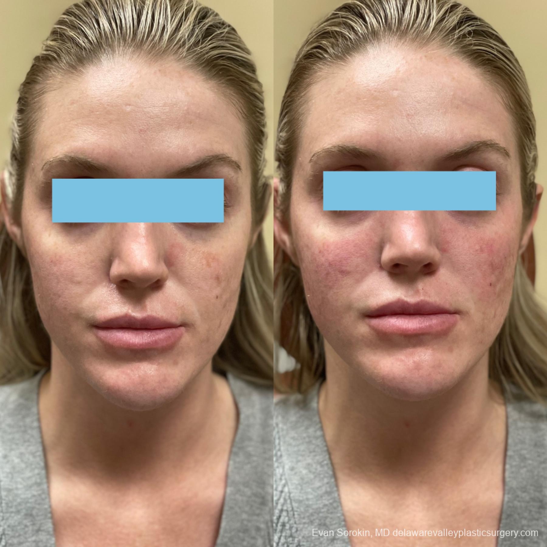Fillers: Patient 46 - Before and After 2