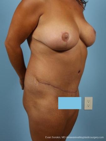 Philadelphia Mommy Makeover 8699 - After Image 2