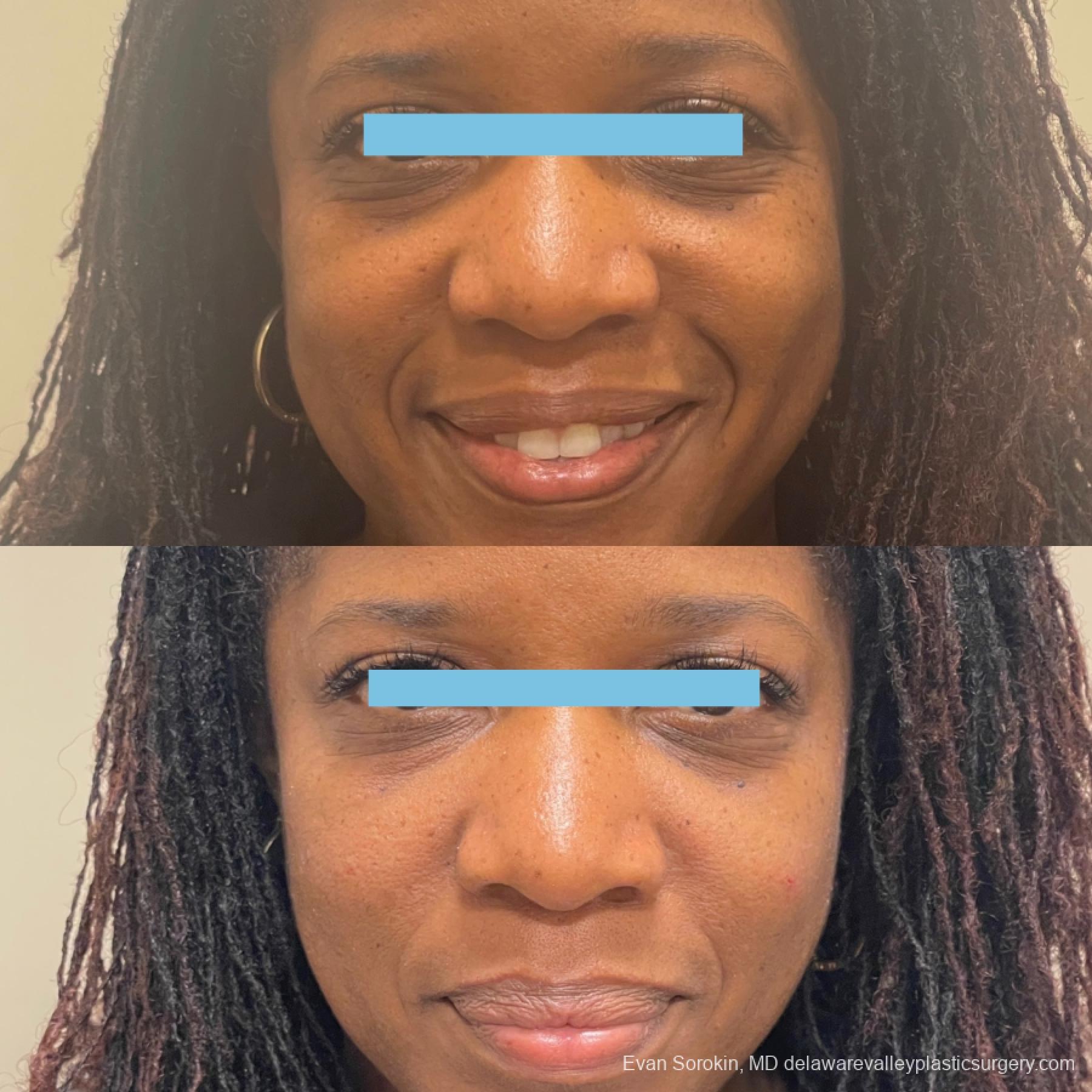 Fillers: Patient 1 - Before and After  