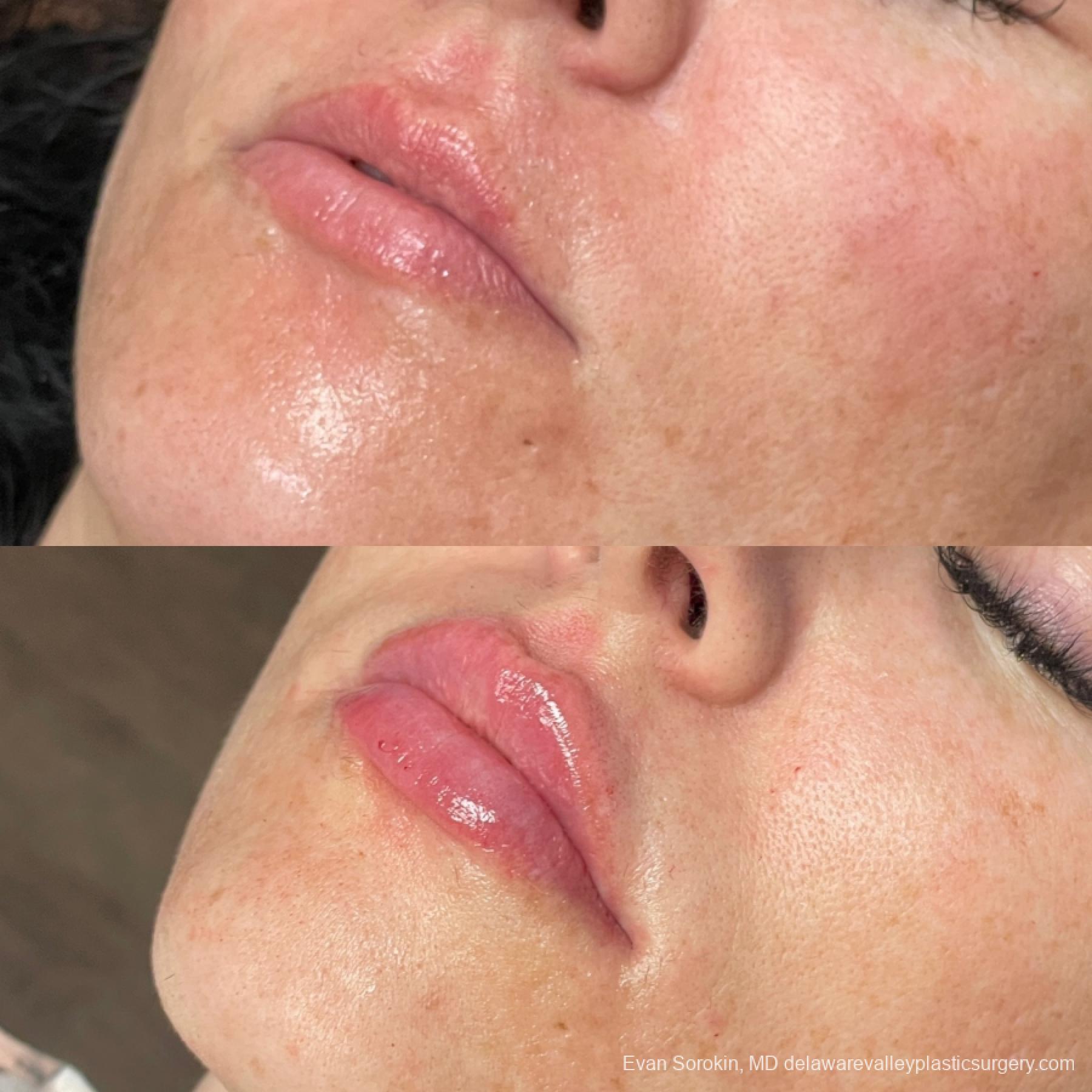 Lip Filler: Patient 65 - Before and After 3