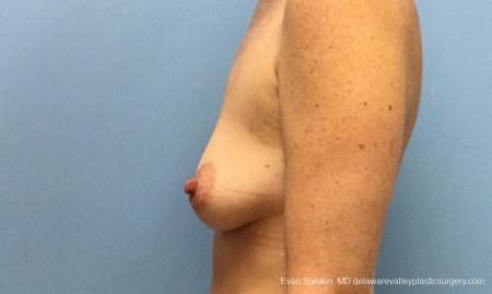 Philadelphia Breast Lift and Augmentation 10814 - Before and After Image 5