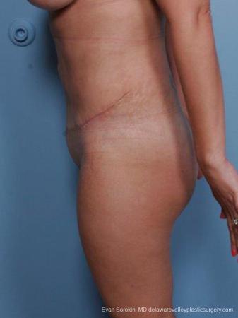 Philadelphia Abdominoplasty 9460 - After Image 5